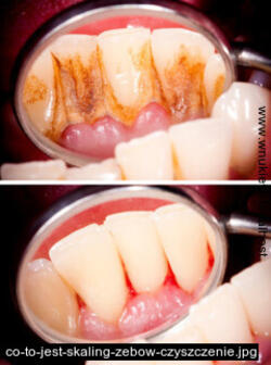 skaling zębów wrocław, leczenie